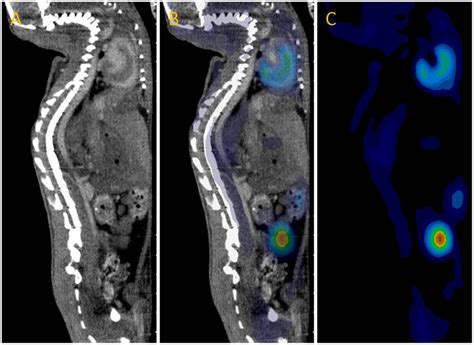 Ct Fused Pet Ct And Pet Images A Contrast Enhanced Ct Image B Fused