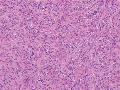 Photomicrograph Shows A Fibrocellular Tissue And Scattered