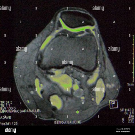 Resonancia Magn Tica De Rodilla Fotograf A De Stock Alamy