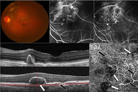 Optical Coherence Tomography Angiography Characteristics Of Polypoidal