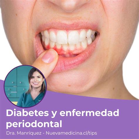 Relaci N De Diabetes Y Enfermedad Periodontal