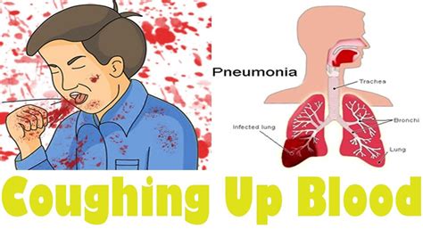 How To Stop Blood Up Cough And Get More Information Here YouTube