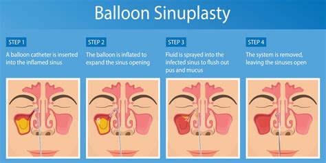 Balloon Sinus Procedures Ohio Head And Neck Surgeons