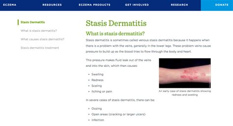 Causes Of Stasis Dermatitis