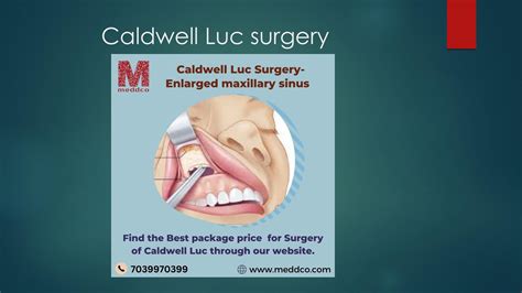 Caldwell Luc Surgery By Meddco Service Issuu