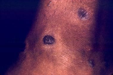 Cutaneous Manifestations Of Hepatitis C Clinical Presentation History