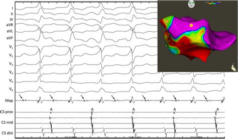 Surface And Intracardiac ECG Recording During Tachycardia In The