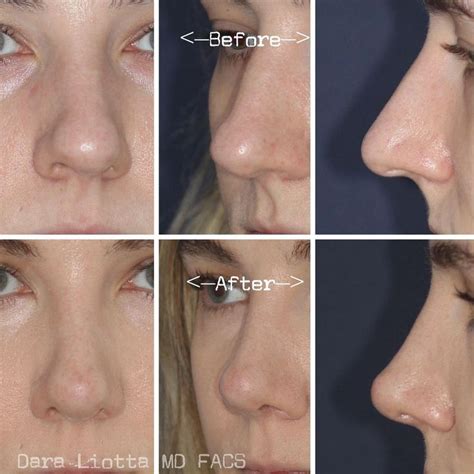 Dr Dara Liotta Md Facs On Instagram Before And Months After