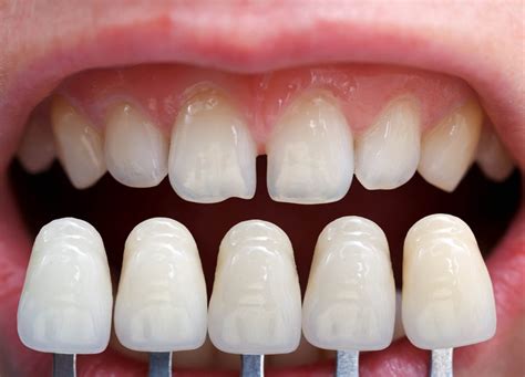 Porselen Laminalar Porselen Di Yaprak Porselen Lotus Dental