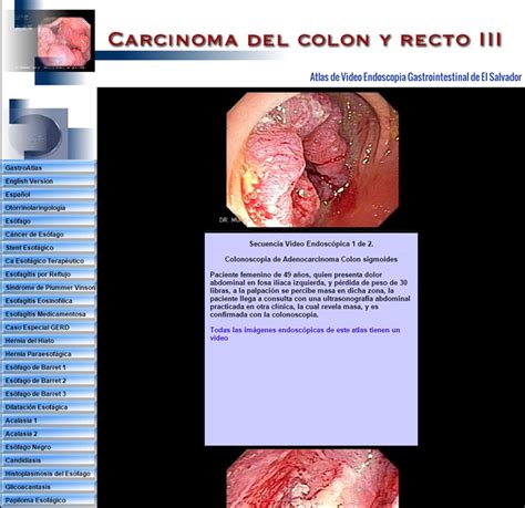 C Ncer Del Colon Gastroenterologia El Salvador Murrasaca