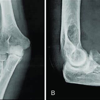 Plain x-ray (A) anteroposterior and (B) lateral views of the elbow ...