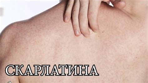 Ръст на болните от скарлатина у нас - има ли усложнения и трябва ли да ...