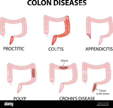 Colon Diseases Proctitis Colitis Appendicitis Polyp Ulcer Crohns Disease Infographics