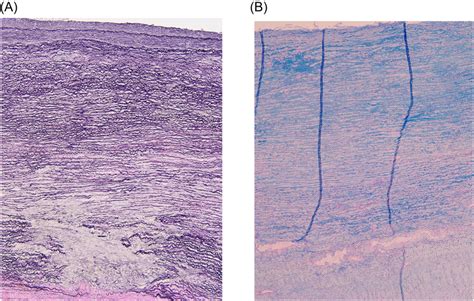 A Elasticavan Gieson Staining Of The Ascending Aortic Wall Showing