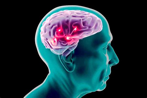 Ictus Cerebrale Sai Riconoscere I Primi Segnali Ecco Quali Sono I