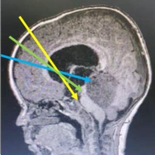 Emergency head CT-scan showing obstructive hydrocephalus (A) by a mass ...