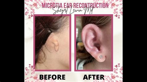 Microtia Ear Surgery 18 Months Post Op Youtube