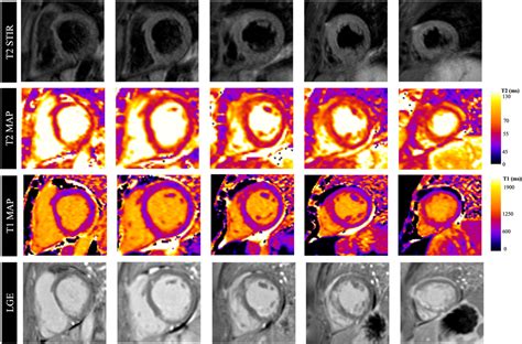 Multiparametric Cardiovascular Magnetic Resonance CMR For The