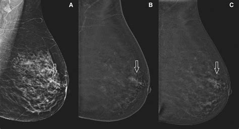 Ductal Carcinoma In Situ State Of The Art Review Radiology