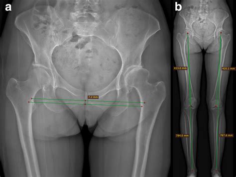 Leg Length Discrepancy Assessment In Total Hip Arthroplasty Is A