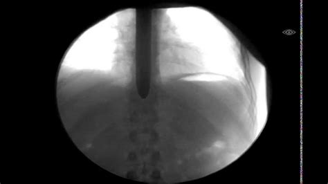 What Happens Inside A Sword Swallower Moving X Ray Of Sword Swallower