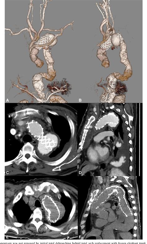 Figure From Transapical Thoracic Endovascular Aortic Repair With A