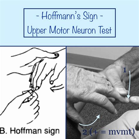 Hoffman Sign