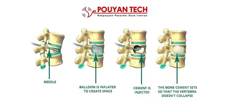 Kyphoplasty – رهپویان پزشکی اسوه ایرانیان