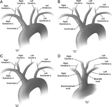 Figure 1. bovine arch and other aortic arch variations | Medical ...