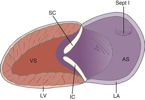 Atrioventricular Canal Defects Clinical Tree