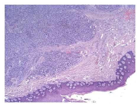 A Hematoxylin Eosin Stain Of The Specimen 2x Hpf B Hematoxylin