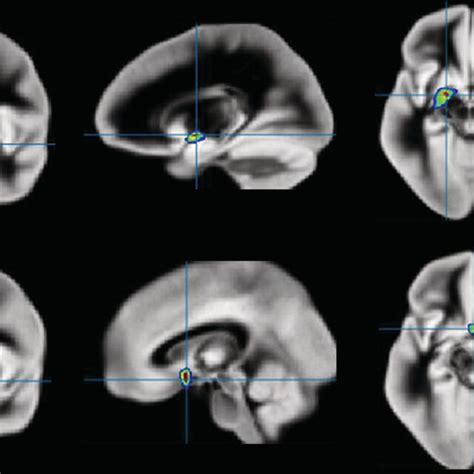 Significant cholinergic basal forebrain volumetric differences among... | Download Scientific ...