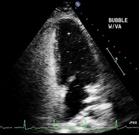 Cryptogenic Adrenal Infarction A Rare Case Of Unilateral Adrenal