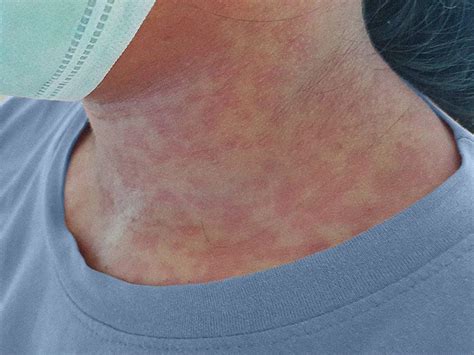 Rubella (German Measles): Symptoms, treatment, during pregnancy