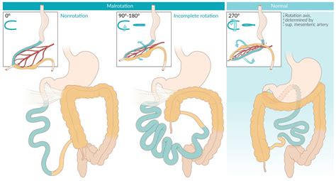 Malrotation With Volvulus