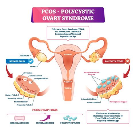 Understanding Pcos And Its Role In Female Hormone Health Style Vanity