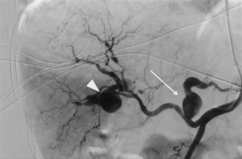 Celiac artery angiogram image showing the pre-embolization image of ...