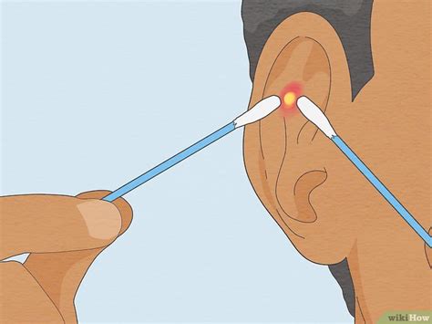 How To Get Rid Of Pimples Inside The Ear 12 Fast Ways