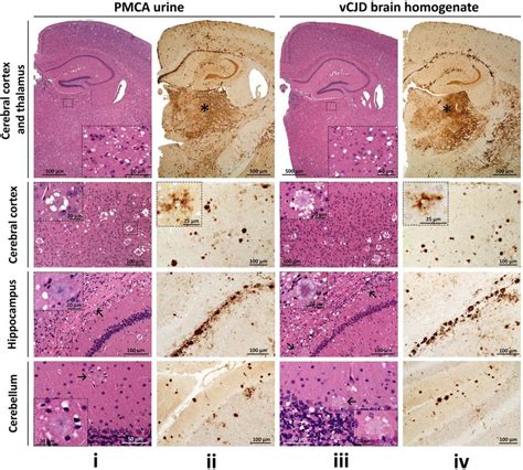 Histopathology And Prp Immunohistochemistry Of Brain Regions From Tg