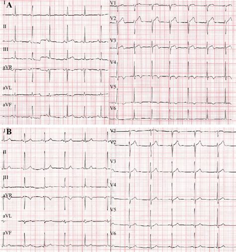 The Patient S Electrocardiography Ecg Showed Sinus Rhythm Biphasic T