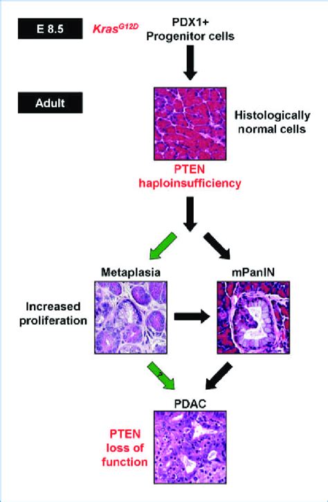 Kras G12d Activation And Pten Loss Collaborate To Promote Adm Mpanin