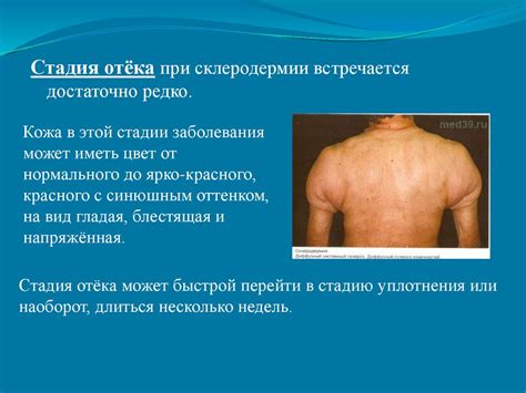 Склеродермия. Диагностика, лечение, профилактика склеродермии - online ...