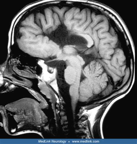 Schizencephaly | MedLink Neurology