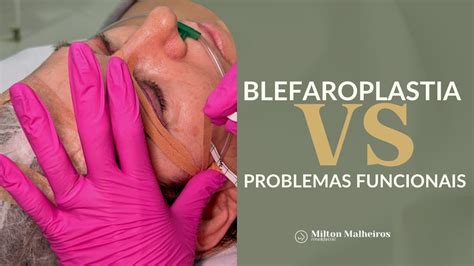 BLEFAROPLASTIA X PROBLEMAS FUNCIONAIS Milton Malheiros YouTube