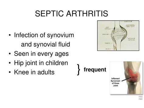 Ppt Septic Arthritis Re At Zaras Md Prof Infection Dept Rozaras