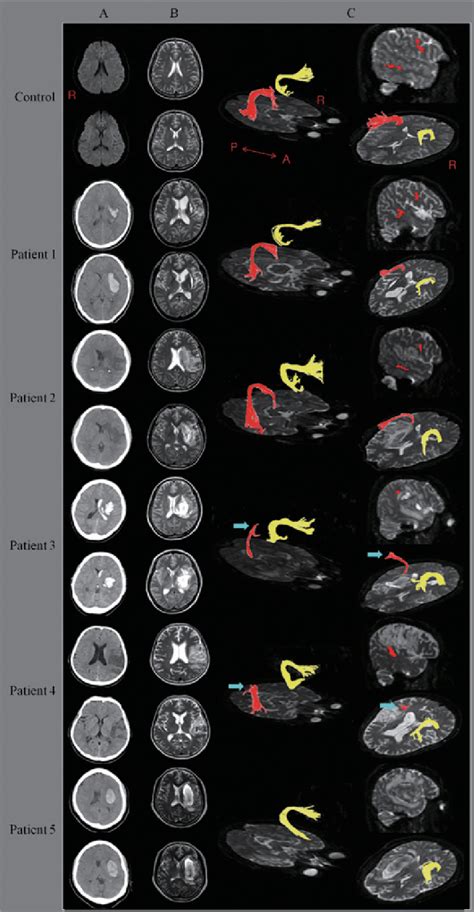 Figure 1 From The Clinical Application Of The Arcuate Fasciculus For