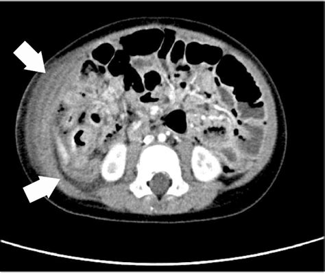 Abdominal CT shows suspicious intraperitoneal and retroperitoneal... | Download Scientific Diagram