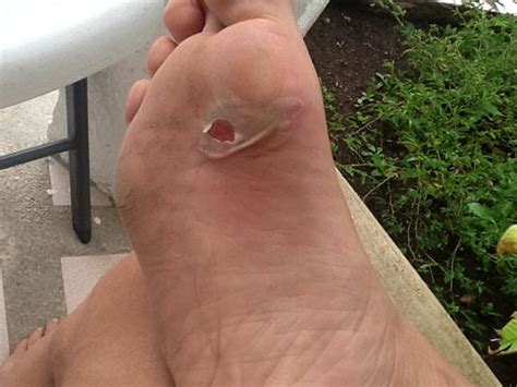 Foot Blister Treatment How To Treat Blisters Properly Blister Prevention