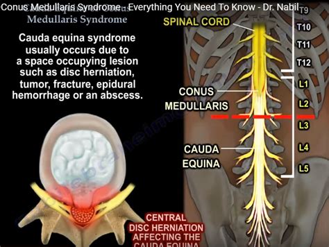 Cauda Equina Vs Conus Medullaris Syndrome - Quotes Resume