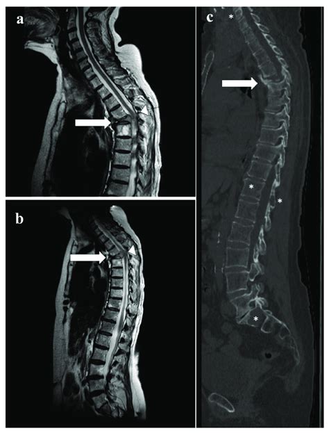 Multiple Myeloma In A 74 Year Old Female With Pathological Fracture Of